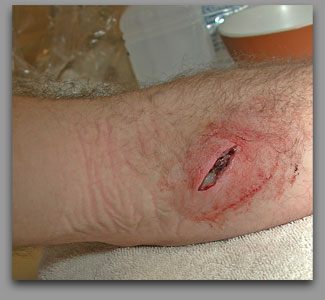 Surgery after arm infection  - click to enlarge